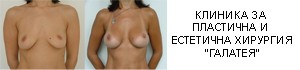 Уголемяване на бюст с импланти