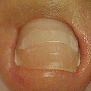 Поставям брекети( скоби ) за корегиране на враснали нокти.  