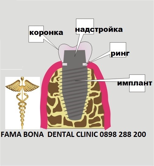 Зъбни имплати в стоматологичен център ФАМА БОНА!